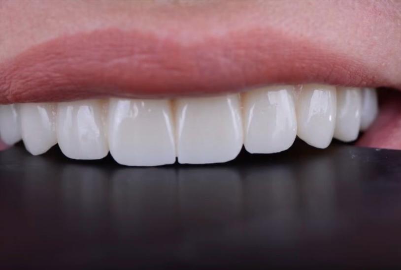 implant üstü zirconya 